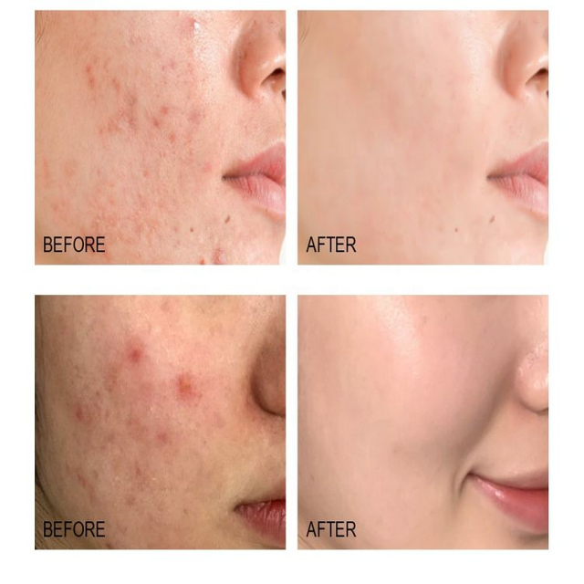 मुँहासे सीरम